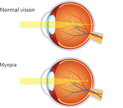 Nearsighted Diagram